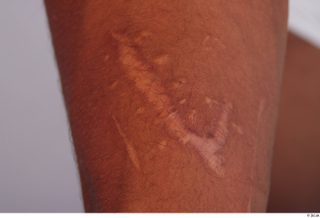 Nabil scar skin 0002.jpg